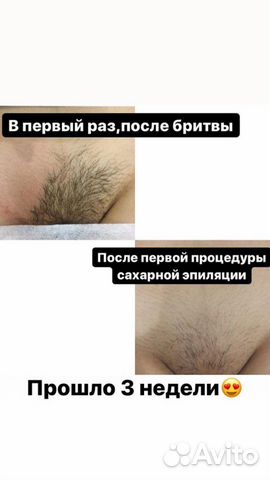 Шугаринг