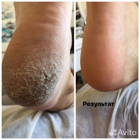 Мужской и женский педикюр smart