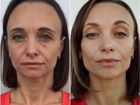 Cuanto cuesta botox en la cara